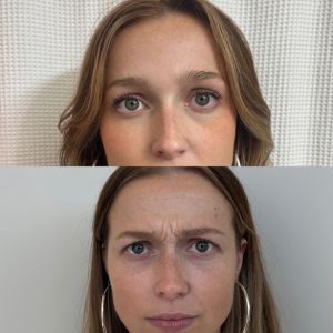 Botox Before/After - 1
