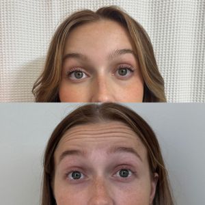 Botox Before/After - 2
