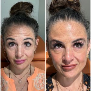 Botox Before/After - 3