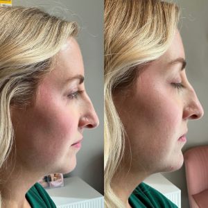 Chin - 3