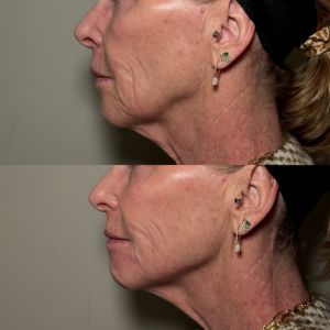 Jawline - 1