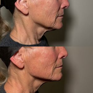 Jawline - 2