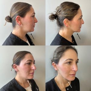 Kybella - 2
