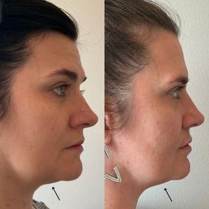 Kybella - 3