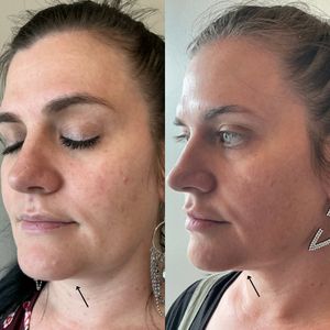 Kybella - 6