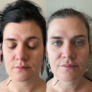 Kybella - 7