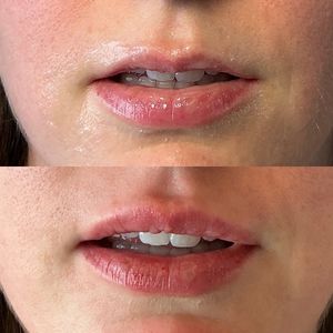 Lip Filler - 1