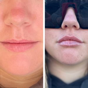 Lip Filler - 10