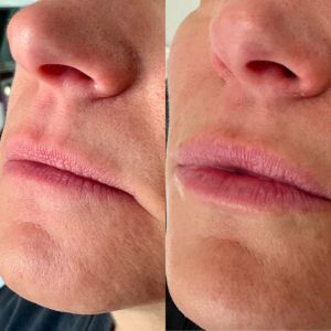 Lip Filler - 11