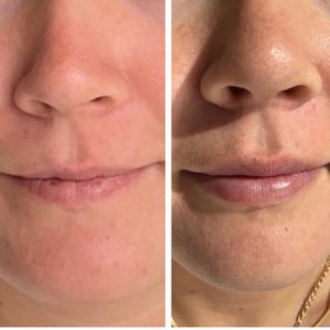 Lip Filler - 12