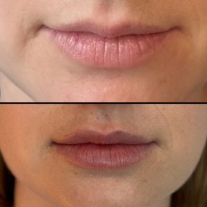 Lip Filler - 13