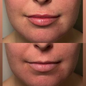 Lip Filler - 14