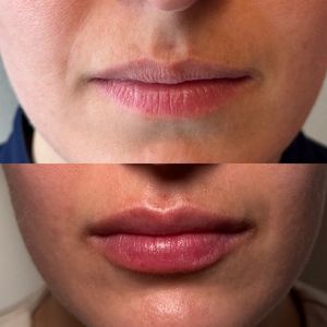 Before and after Kybella treatment