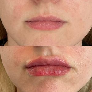 Lip Filler - 3