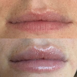 Lip Filler - 4