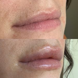 Lip Filler - 5