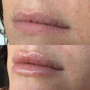 Lip Filler - 6