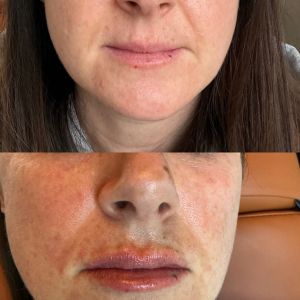Lip Filler - 7