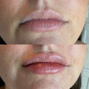 Lip Filler - 8