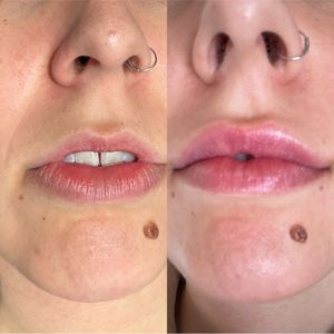 Lip Filler - 9