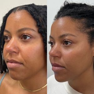 Multi-Modal Facial Balancing VolumaVolux chin and periform , chin botox, PRF underye, volbella lip