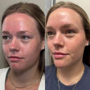 Multi-Modal Facial Balancing Voluma Cheek, Volux Jaw, Vollure Lips, Botox (1)