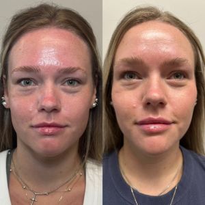 Multi-Modal Facial Balancing Voluma Cheek, Volux Jaw, Vollure Lips, Botox (2)