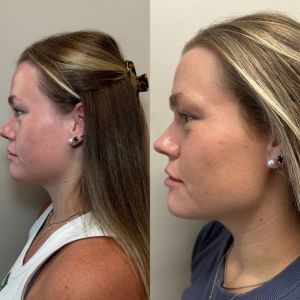 Multi-Modal Facial Balancing Voluma Cheek, Volux Jaw, Vollure Lips, Botox