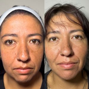 Multi-Modal Facial Balancing Voluma Cheek, Volux Jaw, Voluma Chin & Shadows (1)