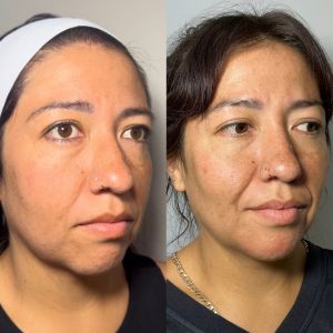 Multi-Modal Facial Balancing Voluma Cheek, Volux Jaw, Voluma Chin & Shadows