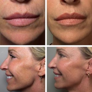 Multi-Modal Sculptra, Skinvive Botox, CO 2 Laser