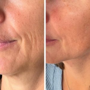 Multi-Modal Sculptra x 2 rounds, Voluma in the cheeks, Volbella etch out those deeper lines